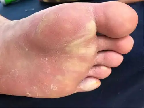 长距离的湿袜子脚底全部水泡,磨破了,大腿2侧全部磨破了,有时傻到极点