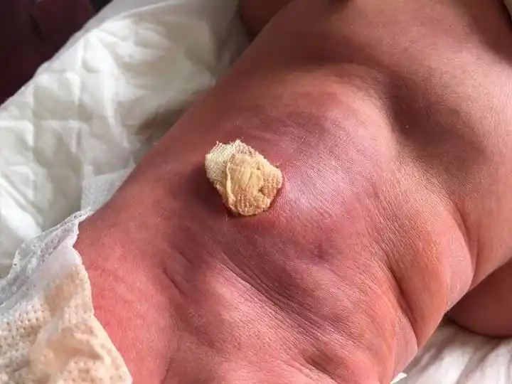 睡了凉席7天大的娃满身脓包 凉席怎么清洗很有讲究