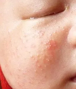 分类:儿科 患者信息:女  病情描述(发病时间,主要症状等): 二十