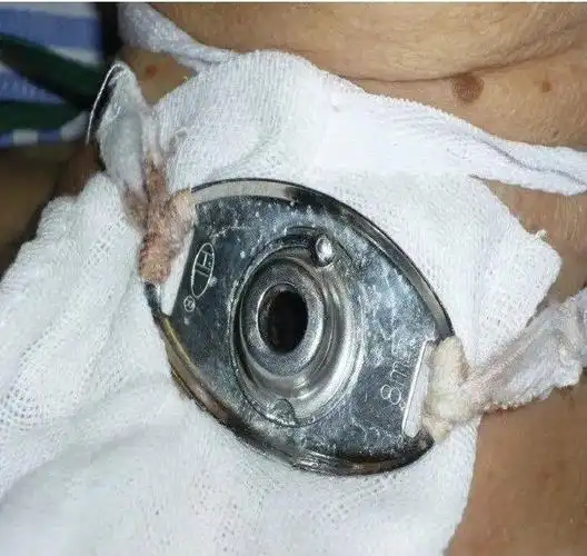 喉癌患者气管套管的护理