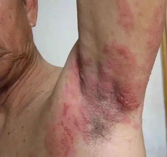 男性一期梅毒图片49