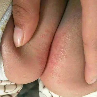 宝宝患了尿布疹该怎么护理?
