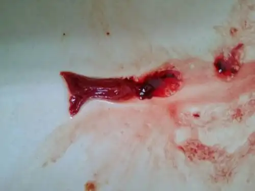 来月经排出一条血鱼,好恐怖啊,有图,怎么回事