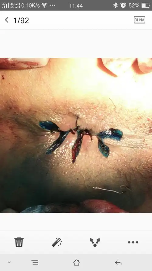 环状混合痔嵌顿术前术后图片对比