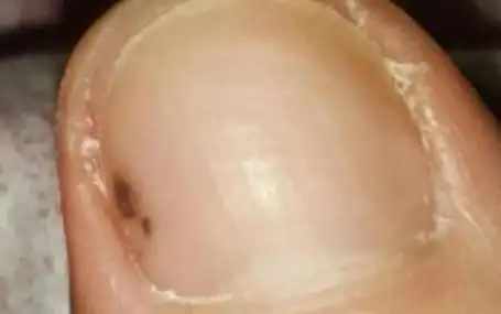 指甲长这种斑竟是恶性肿瘤前兆图