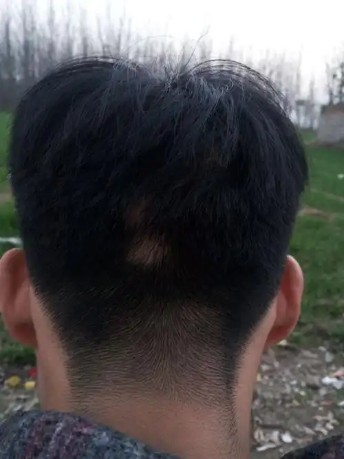 我的后脑勺有一处硬币大小没有头发 是什么原因?我才20岁