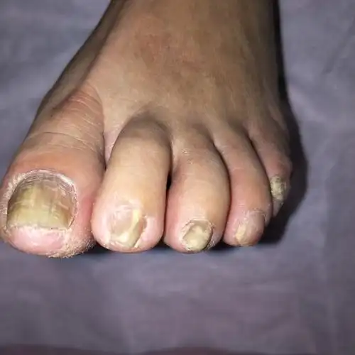 为什么灰指甲不能自愈呢?