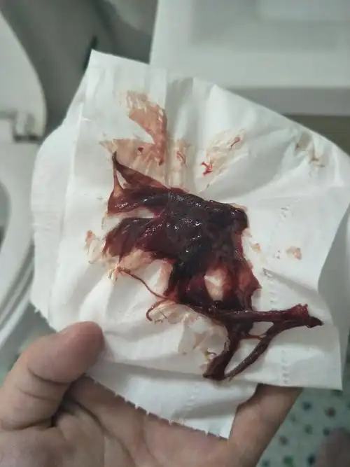 有图介意勿入,子宫内膜脱落.今天月子16天.有人流 | 妈妈网轻聊_千万