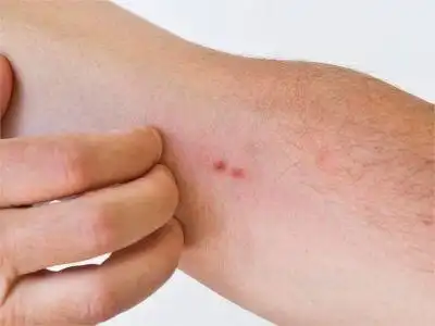亚急性接触性皮炎胳膊上起了小红疙瘩图.jpeg