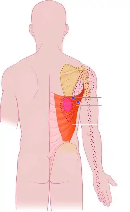 肩胛骨下角疼痛怎么治?_疼痛_疼痛缓解方法 - 好大夫在线