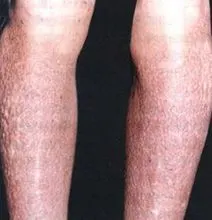 原发性限局性皮肤淀粉样变