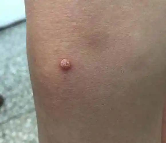 瘊子图片瘊子有传染性