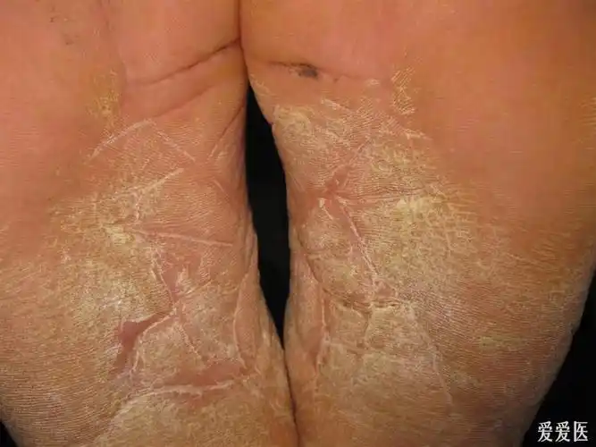 看图识病1手神经性皮炎2足底角化性湿疹