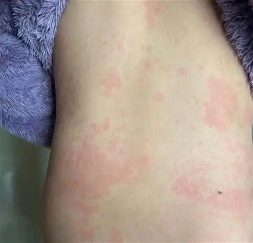 第一次发荨麻疹,我们老家叫发风坨,脸上和身上全部是大面积的红 - 抖