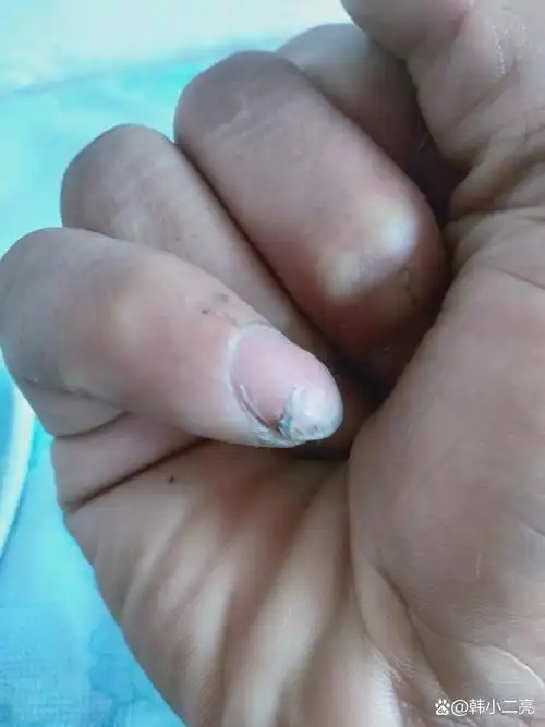 手指甲中间断了,这是怎么回事,还老是长肉刺,老疼了