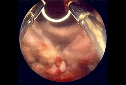 经尿道前列腺电切术