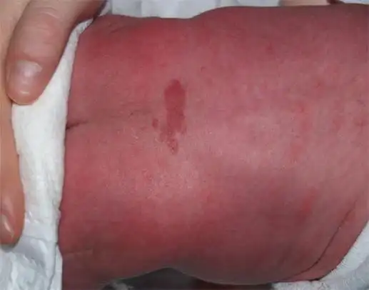 宝宝屁屁上方有个小凹陷用不用担心