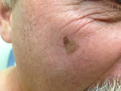 手背上黑色素瘤早期症状图片