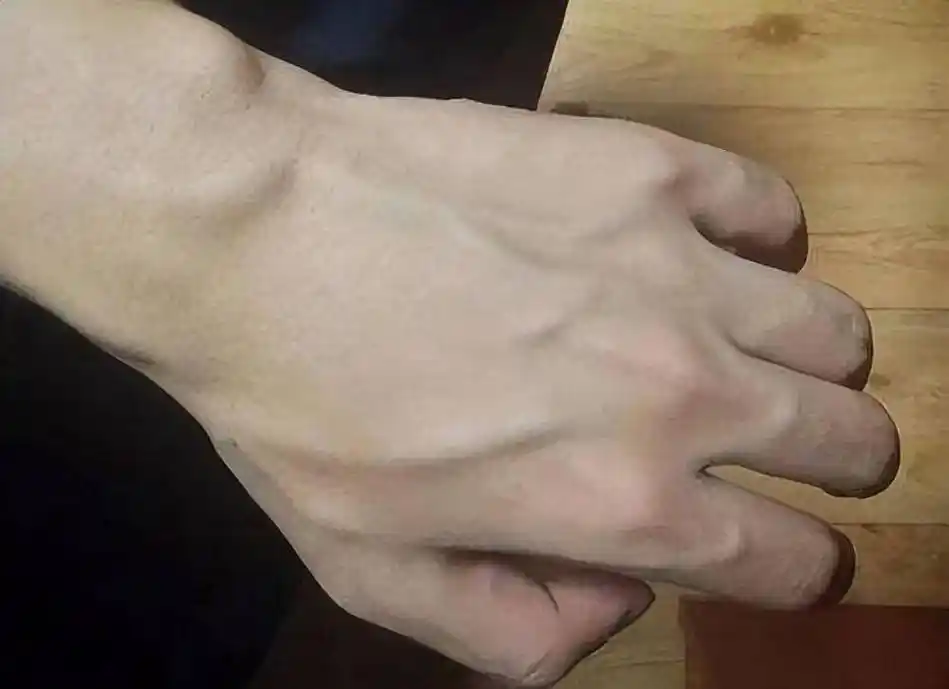有的人手臂"青筋暴起",有的人几乎看不到青筋,哪种更健康呢?