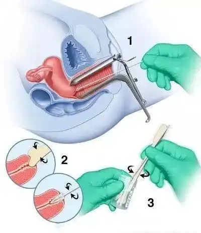 双合诊 先别急着起身,因为此时子宫和卵巢的情况在上述步骤还看不到