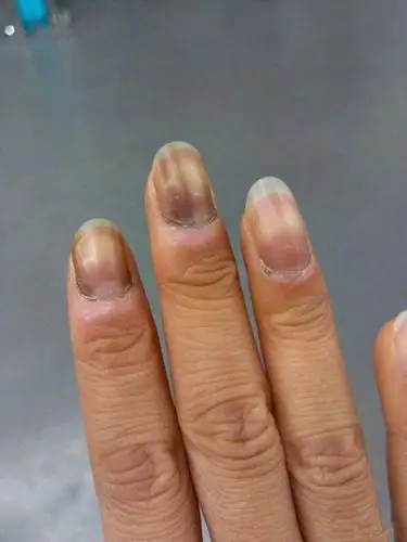 甲母痣早期图片 (32)_有来医生