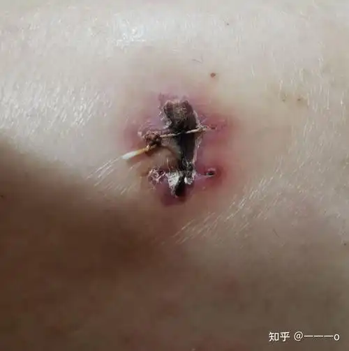 我连涂三四天面霜在伤口周围皮肤上,以前反复过敏的地方变平滑很多