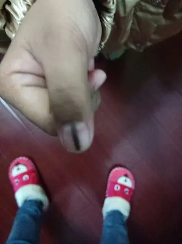 我家小孩指甲上长的黑线,求大神给指点一下,这是什么原因啊?