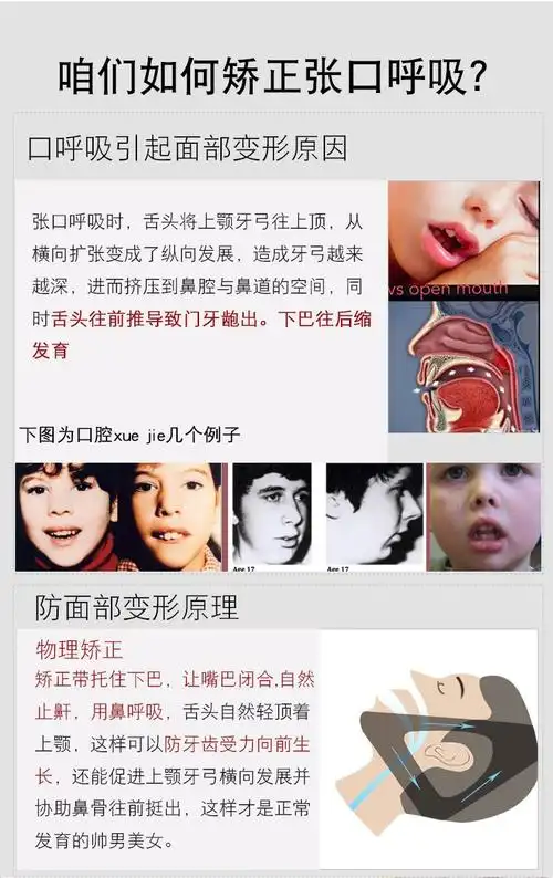 睡觉防止嘴巴张开流口水防睡觉张嘴包脸带儿童防止张嘴 t14-g【双托