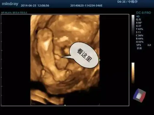 想知道男女四维彩超就可以帮助你辨别男孩女孩