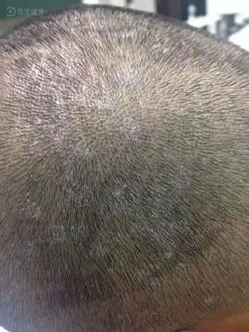 头部白癣的诊断与治疗