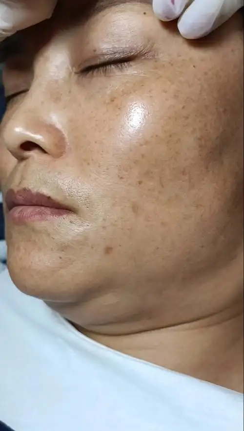 黄褐斑 雀斑 黄气  晒斑  细纹,同步打造,马上操作