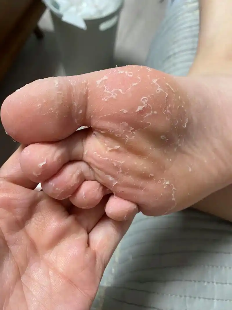 三岁小脚就开始起皮,最开始没这么多,今年就九岁更严重了.