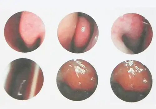 鼻塞,流涕10余年 不只是鼻炎作者:南京仁品 | 点击:72