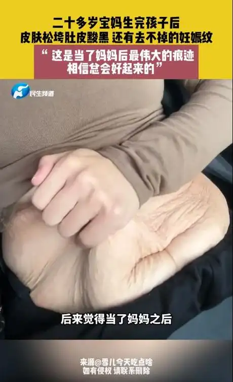 宝妈晒产后满是妊娠纹的肚子网友好吓人大多数都不是这样的