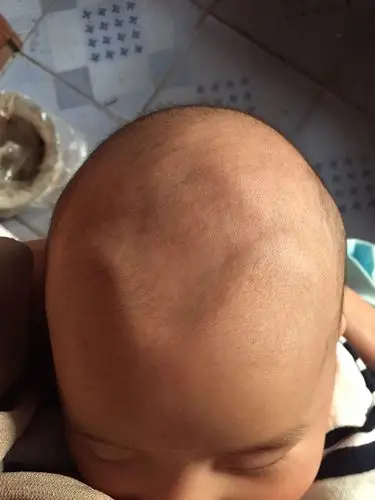 宝宝这几天卤门突然这么凹陷 之前平平的 没有这么