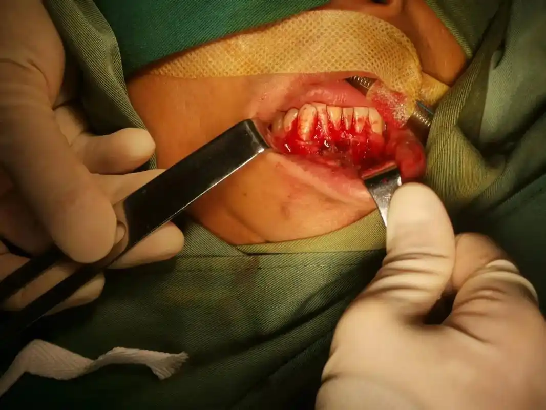 颌骨囊肿,两个半小时手术!昨天三小时拔颗牙!别问为什么,别问 - 抖音