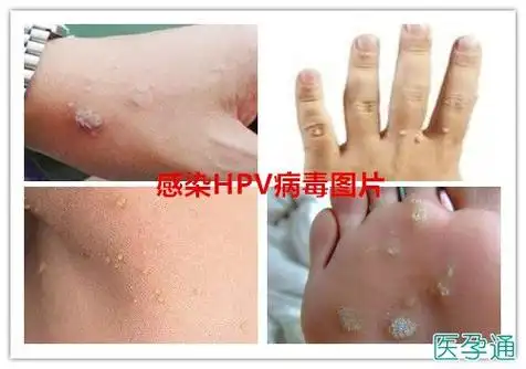 什么是hpv病毒携带者附hpv病毒感染的症状图片