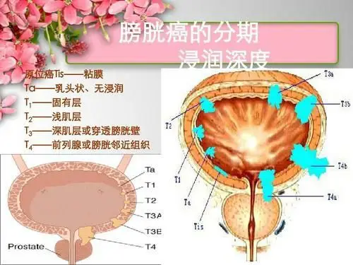 膀胱癌的分期