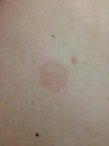 身上起了好多红色斑块,腋下很大一块～胸前硬币大小一块块～不疼不痒