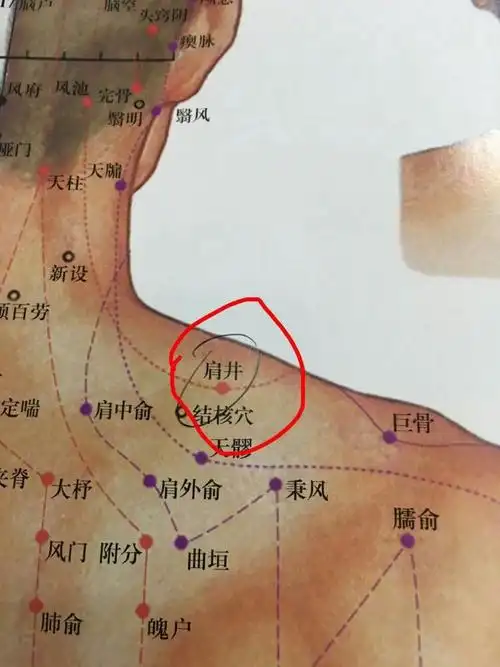 肩周炎引起手酸手麻贴法