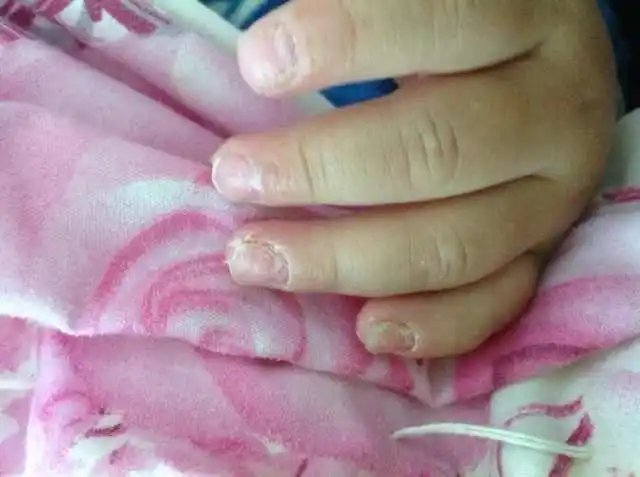 宝宝10个的时候有一个手指甲有点凹凸不平,医生也说不出什么原因,看了