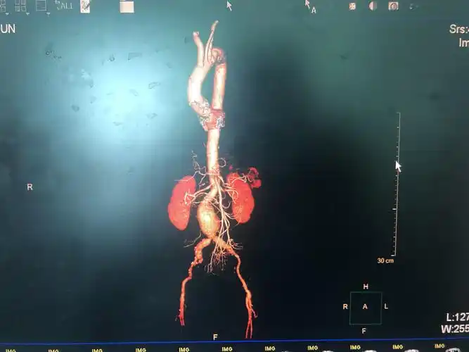 75岁男性患者三维重建