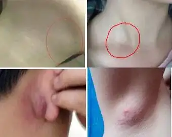 小孩颈部淋巴结肿大:是什么原因?如何治疗?医生带你了解一下