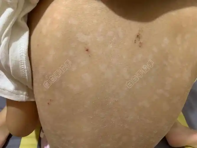 我家宝宝今年8月16号诊断是炎症后的白斑!