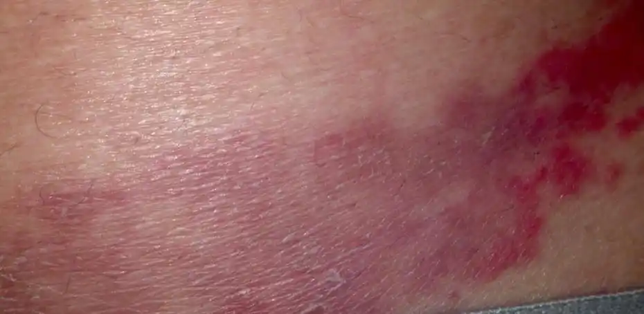 不太好意思去医院看 有点红斑 不知道什么疮一到晚上就痒