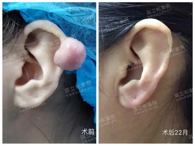耳廓疤痕疙瘩术后近两年随访 - 好大夫在线