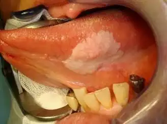 口腔白斑及扁平苔藓的治疗介绍