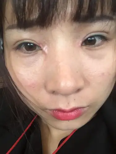 我做全切双眼皮两个月了眼角依然增生,而且有白点怎么办,有时候还疼的