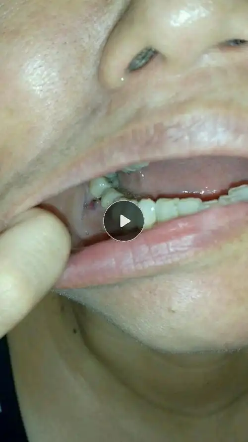 牙齿旁边长了一个红色的血包,已经一个月没有消,有时候消一点点一会儿