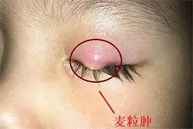 儿童橘子眼的症状及图片